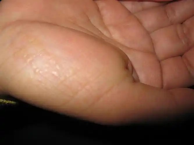 看图识病---------播散性掌跖角化病