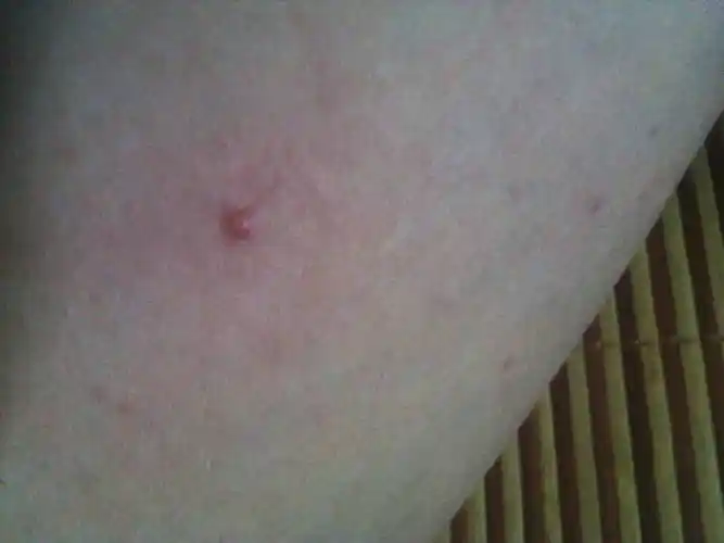 阴茎上为什么会长痘痘