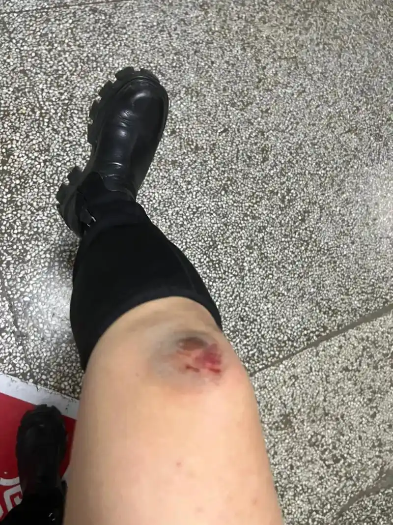 心疼我的人在哪里 ,女儿骑电驴带我摔了,女儿胳膊摔骨折了, - 抖音