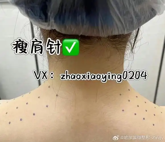 医美##瘦肩针##瘦肩针77瘦腿针##哈尔滨瘦肩针##瘦肩