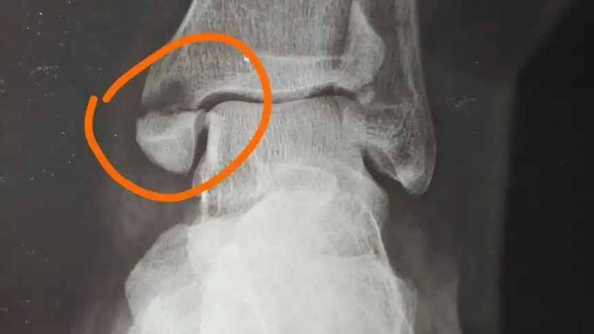 脚内踝骨折片子