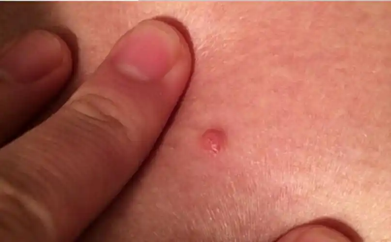 二期梅毒感染图片男性二期梅毒感染女性图片二期梅毒感染潜伏期的三大