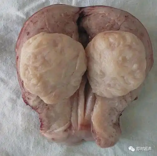 粘膜下肌瘤|浆膜下肌瘤|子宫肌瘤|宫颈肌瘤|-健康界