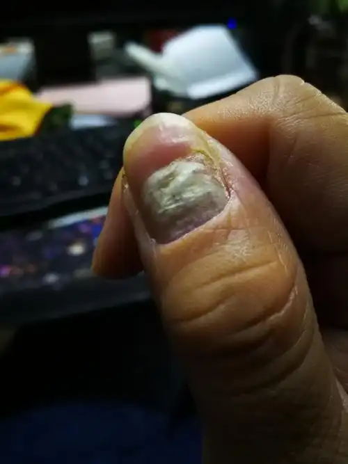 大拇指指甲不知道怎么了,求解