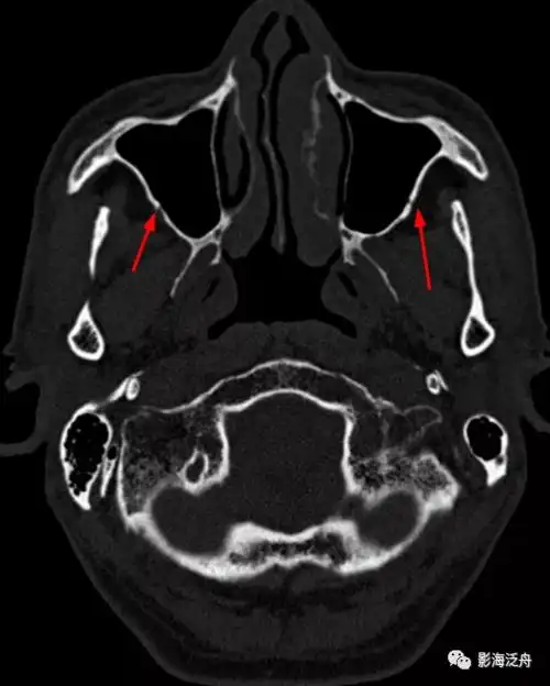 夜班不求人颅骨骨折下