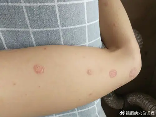 给银屑病治疗增添一种全新的康复方法.