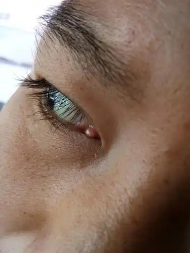 眼角长个这,这是什么