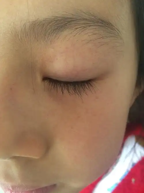 孩子的眼睛周围起了很多小红点,需要去医院吗,在线等