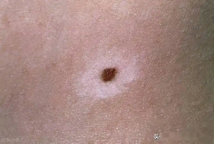 皮肤科医生和你聊聊:色素痣变白了?怎么回事?是白癜风吗?