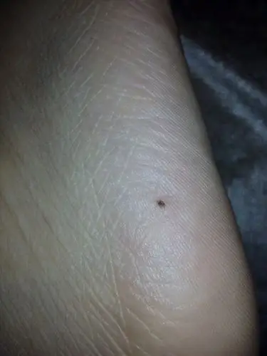 医生您好最近发现脚上有一个黑点用手摸摸没有痛感好像就