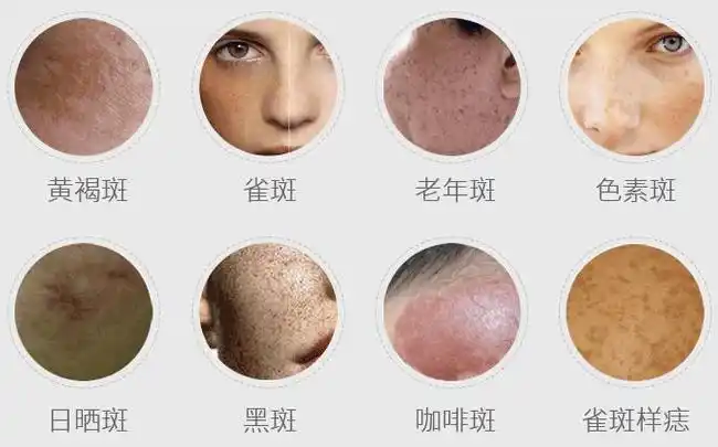 秋季祛斑正当时这样效果更好