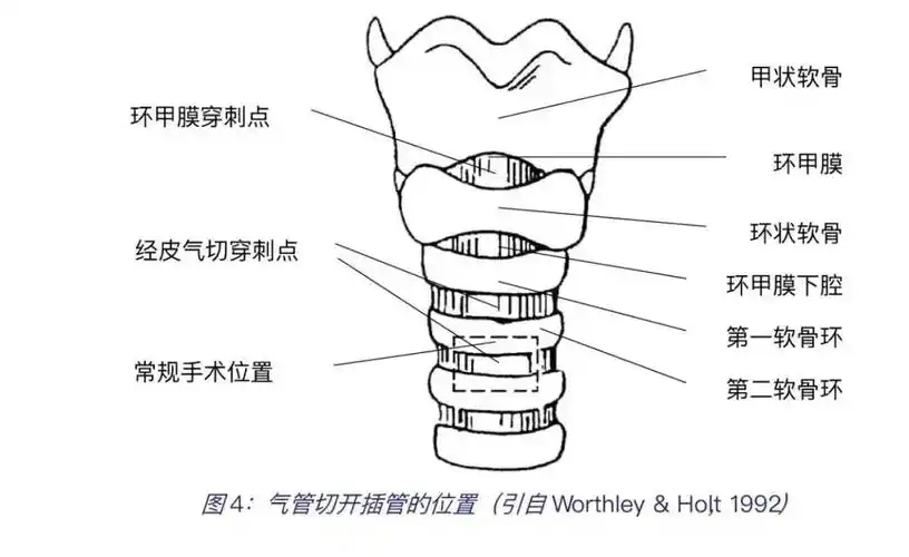 环甲膜气管切开术(cyclophated tracheotomy)经皮气管切开术
