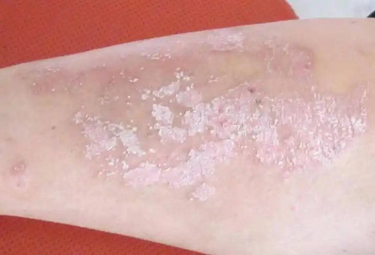 长春肤康医院浅谈患牛皮癣可以做运动吗