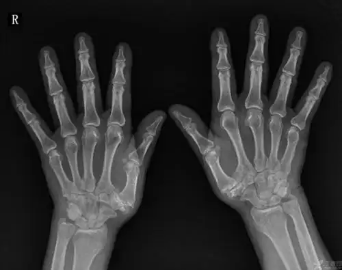 患者男,68岁,自诉双侧腕关节肿痛2年.