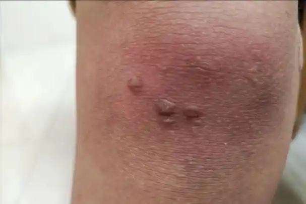 人乳头瘤病毒早期图片,人乳瘤头病毒是什么(hpv和病毒疣都啥模样)