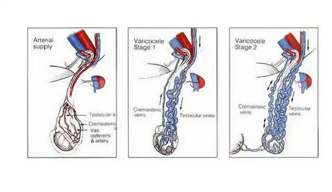 精索静脉曲张的治疗_精索静脉曲张_精索静脉曲张治疗方式 - 好大夫