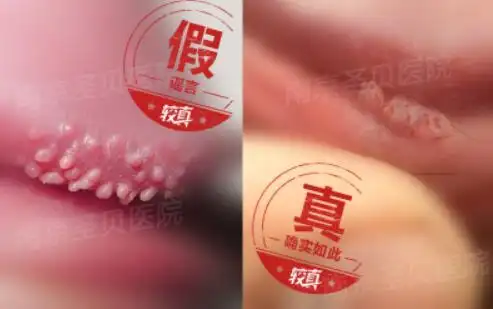 假疣真疣图片对比辨别