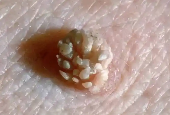 私处长肉疙瘩,一定是得性病了?