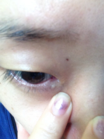 眼角长了个疙瘩图片 (42)