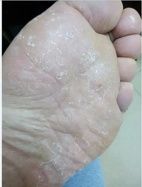脚上起皮,不痛不痒