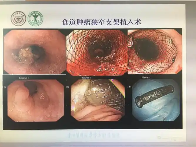 食道肿瘤狭窄支架放置治疗 - 好大夫在线