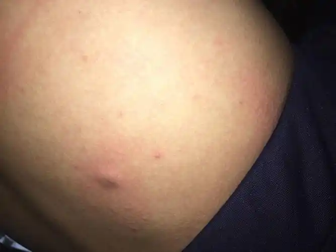 后腰上长了个黑色的(有点像搓出来的灰的那个颜色)