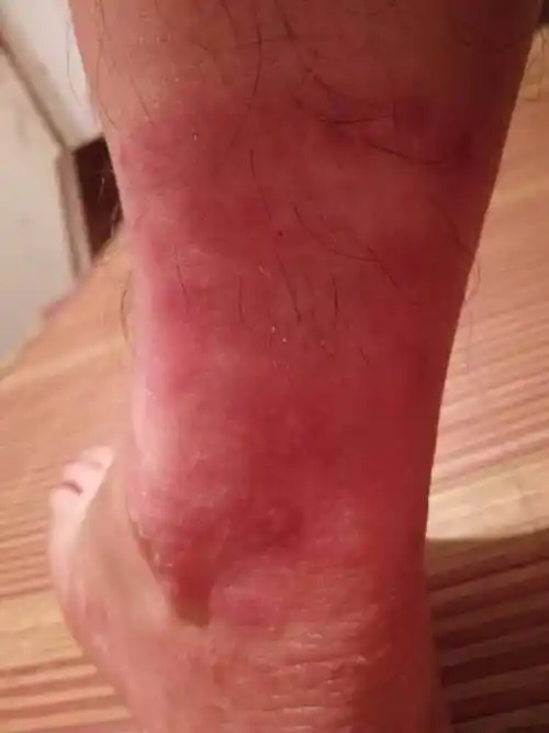 去皮肤科医院看了说是癣.抹了一个星期的药膏还是不见好转