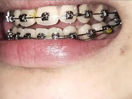 自锁托槽矫正术后409天_牙齿矫正术后409天_牙齿美容术后409天_郭大侠