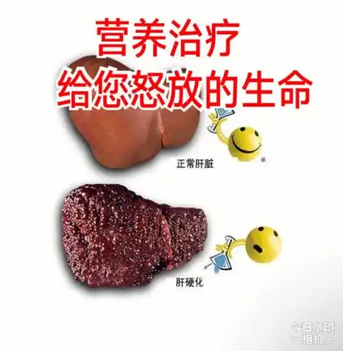 诊断早期肝硬化需要做哪些检查?