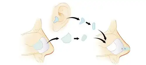 自体软骨隆鼻卡通图