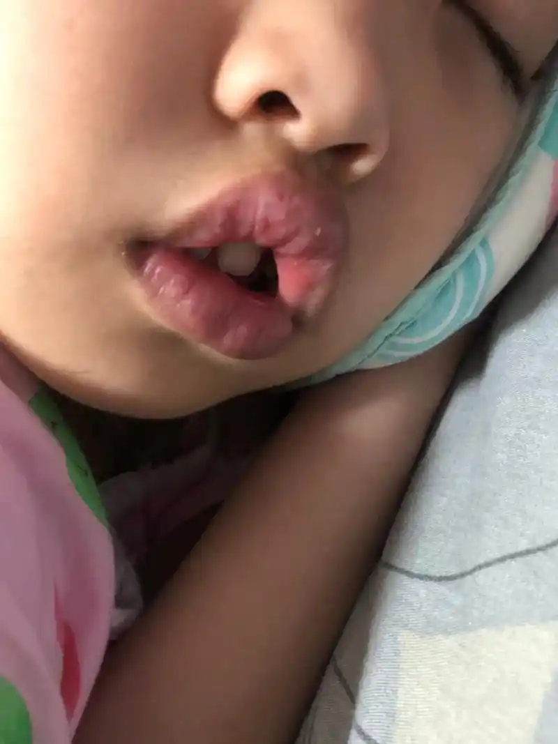 孩子腺样体肥大,保守治疗很简单