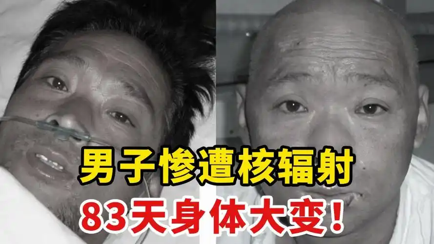 日本男子惨遭核辐射,83天亲眼看着自己被融化,死状触目惊心