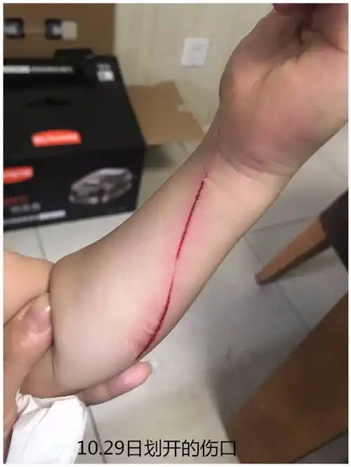 梦到自己胳膊受伤流血 梦到自己胳膊受伤流血不止
