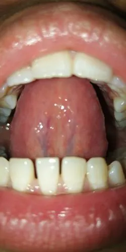 舌下络脉紫色,瘀血结节,有寒凝热郁