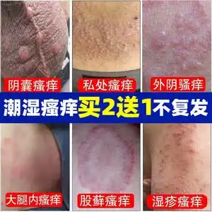 治阴囊瘙痒去潮湿男女私处蛋蛋痒大腿两侧止痒膏冰霜阴茎部体湿痒