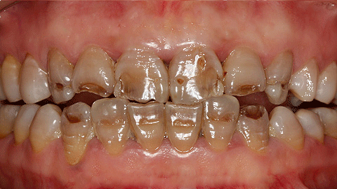 牙齿美白中心         3,重度氟斑牙         牙齿除了广泛着色外