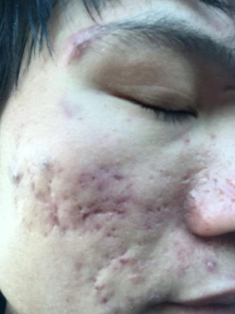 痤疮疤痕去除 简单有效的方法分享