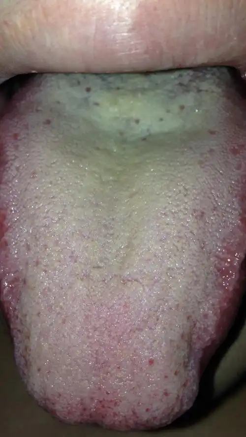 请教中医脾胃问题,舌苔很厚,有图