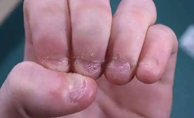 辟谣,孩子咬指甲就是缺钙?错,孩子可能是"咬甲癖"