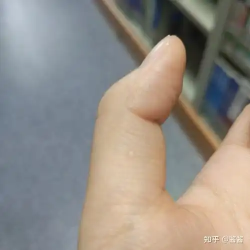最近发现手上长了好多白色透明的小颗粒,不痛不痒,一小颗一小颗的
