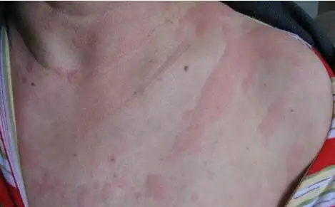 十年"荨麻疹"?三个月的功夫就好转了?