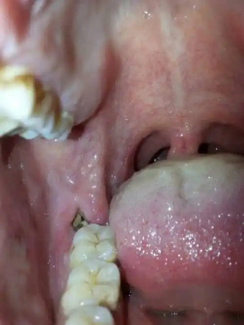 智齿拔掉后的第7天,请问照片上的情况正常吗?