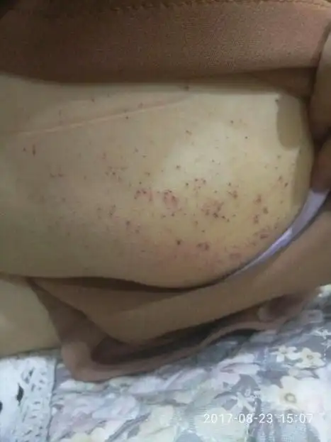 屁股上长了很多密密麻麻的红血疙瘩 不疼不痒 用针扎破全是血 好了