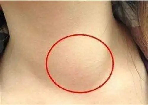 甲状腺癌是最善良的癌(甲状腺癌早期的8个症状图片) - 生活 - 影豆网