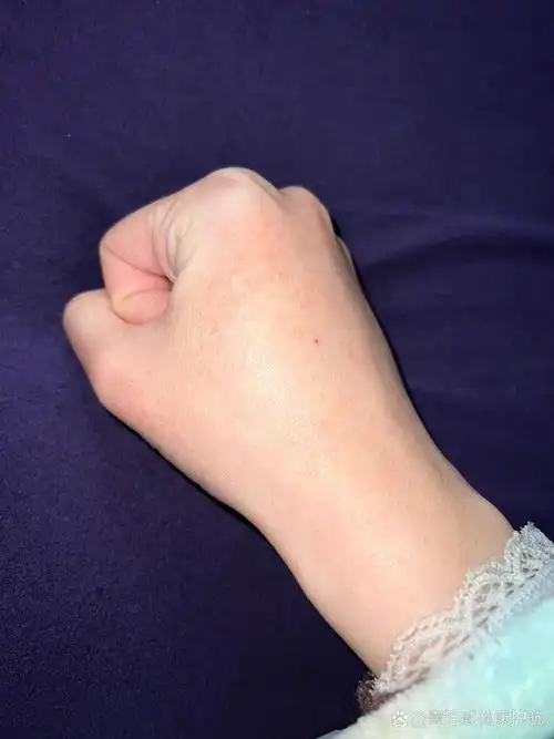 手背起红点 一块一块的