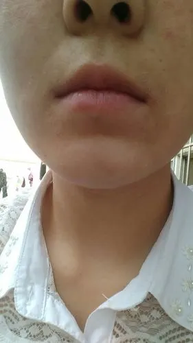 最近几天脸上突然起了一块一块的白癣,还起皮,也没乱用什么化妆品呀!