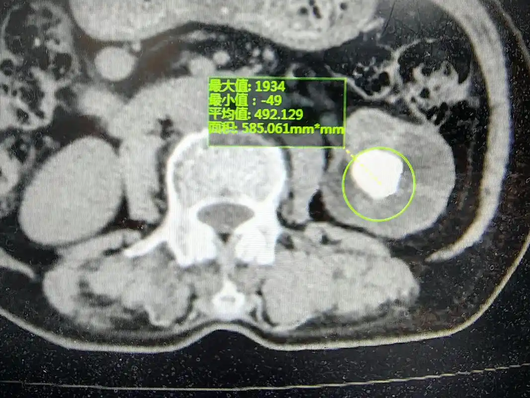 肾结石的硬度已经颠覆了医生的认知,肾结石的ct值了解一下