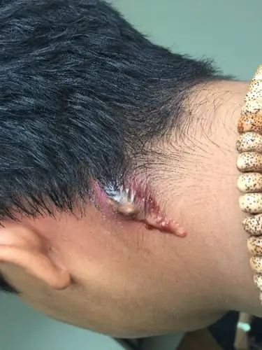 火疖子有十多天了,应为刚开始长的时候用手挤压,造成了感染,化脓严