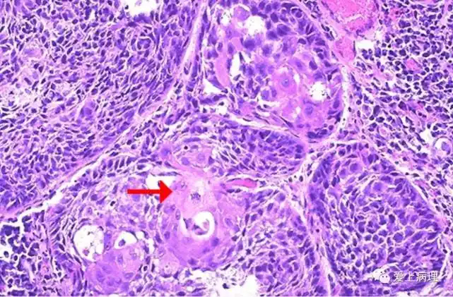鸦胆子油的功效与作用鸦胆子油软胶囊是一种抗癌的药,消化道肿瘤,肝癌