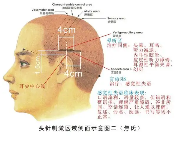 焦氏头针之 " 天龙八步 "(附手机屏保图片)